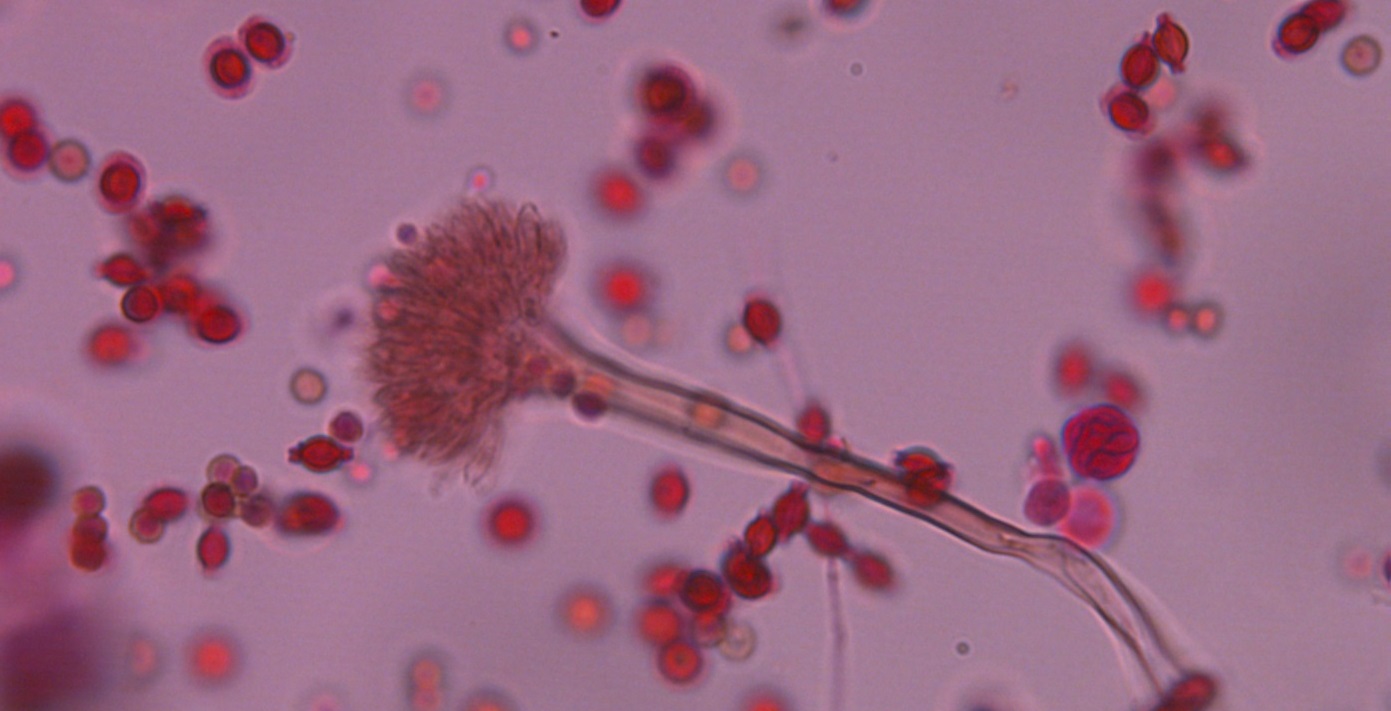 Aspergilosis